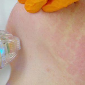 Trio: IPL, RF Nano-Fractional Resurfacing & Facial Contouring