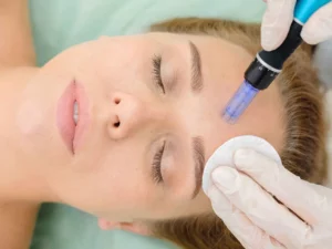 Polish-Plus.-microneedling